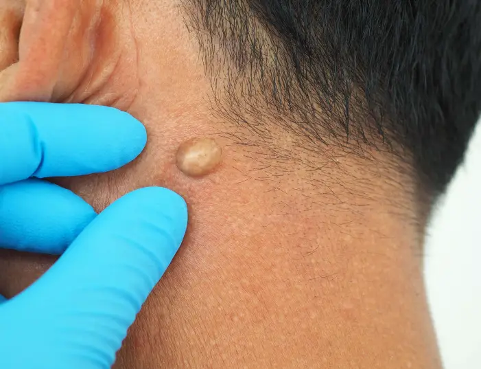 gta cyst removal on neck