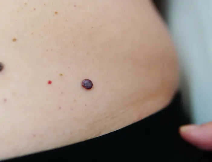 mole removal toronto patients hip