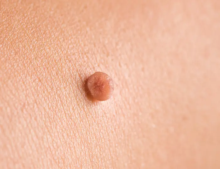 skin tag on arm in toronto