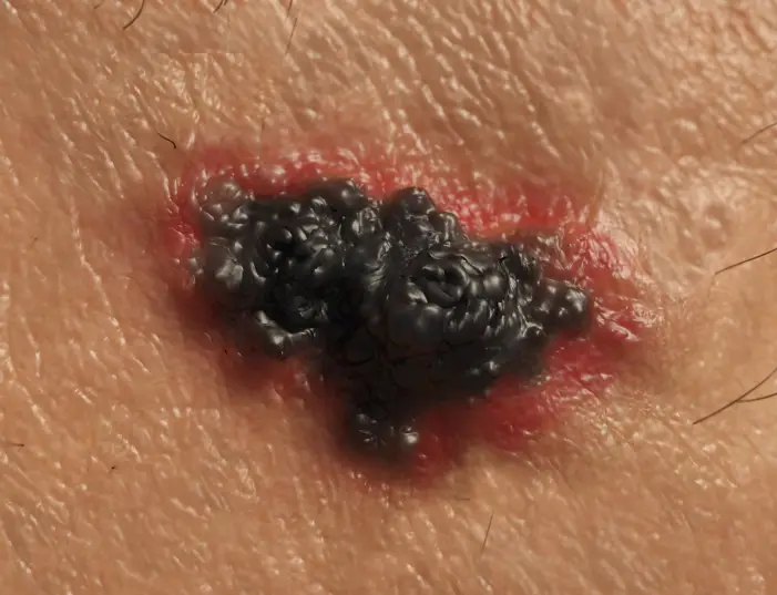 toronto skin cancer treatment